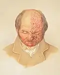 Image of a lithograph from Hebra's Atlas showing a bald man, his head slightly bent down, with herpes zoster (shingles) on face and pate.