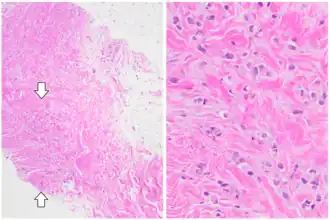 ILC may be subtle on low magnification (left). Higher magnification (right) shows invasive growth pattern and vesicular nuclei with prominent nucleoli.