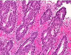 Poorly differentiated colorectal carcinoma