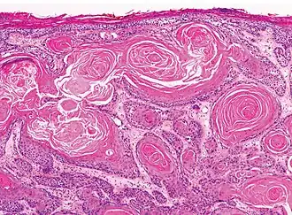 Well-differentiated (yet invasive) cSCC, showing prominent keratinization. It may form pearl-like structures where dermal nests of keratinocytes attempt to mature in a layered fashion. Well-differentiated cSCC has slightly enlarged hyperchromatic nuclei with abundant amounts of cytoplasm. Intercellular bridges will frequently be visible.[12]