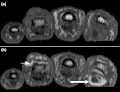 T1 weighted axial MRIs of the fingers in PsA. (a) Pre- and (b) post-contrast showing dactylitis due to flexor tenosynovitis at the second finger with enhancement and thickening of the tendon sheath (large arrow), and synovitis at proximal interphalangeal joint (small arrow).