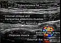 Abdominal ultrasound showing a normal appendix between the external iliac artery and the abdominal wall