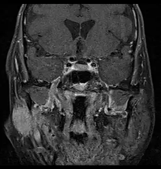 Coronal MRI showing right parotid adenoid cystic carcinoma with perineural spread of tumor: The tumor originates in the right parotid gland and spreads along the trigeminal nerve via the auricuotemporal branch extending intracranially through the foramen ovale at the skull base towards Meckel's cave.