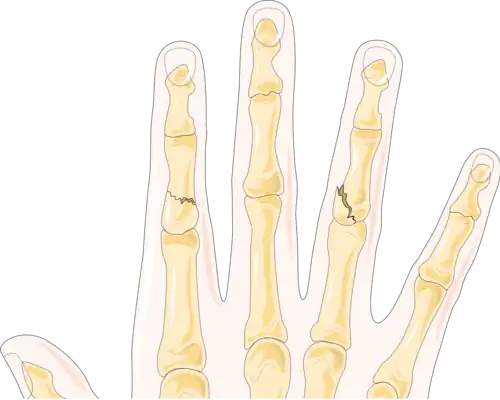 On the index finger, a fracture of the shaft that does not affect the joint. On the right, a fracture affecting the ring finger's proximal interphalangeal joint, or PIP joint