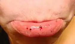 Oral petechiae/purpura — lower lip