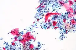 Squamous Cell Carcinoma, bronchial washing.